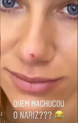 Giovanna Ewbank machucou o nariz e compartilhou fotos com os seus fãs (Foto: Instagram)