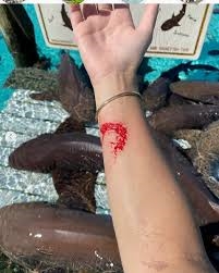 Mordida de tubarão no braço de Ana Bruna Avila (Foto: Instagram)
